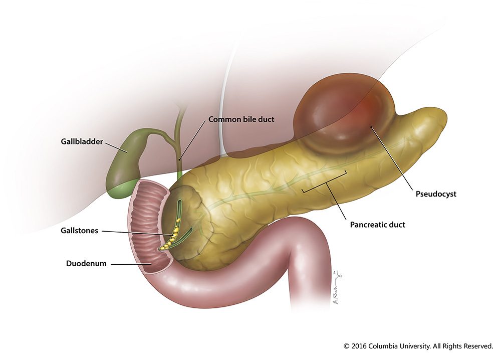 pancreas_acute_pancreatitis