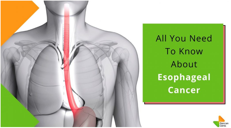 All You Need To Know About Esophageal Cancer