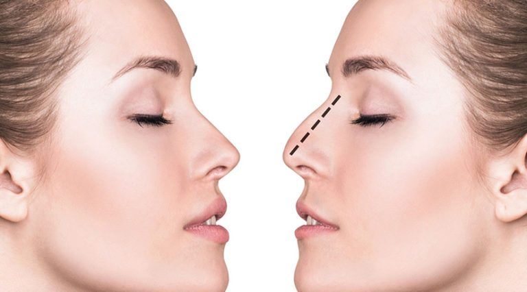 Rhinoplasty Explained | Facts About the Surgery
