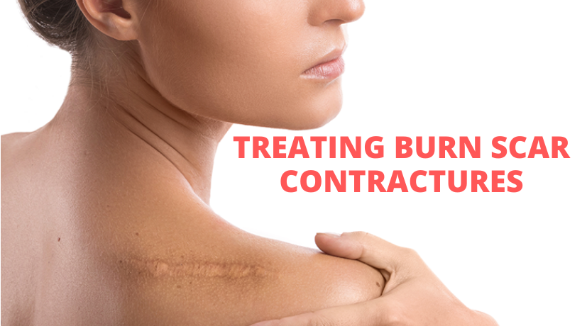 TREATING BURN SCAR CONTRACTURES