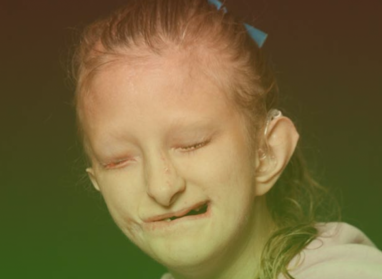 Gorlin Syndrome Treatment in Pune | Basal Cell Nevus Syndrome | Deccan ...